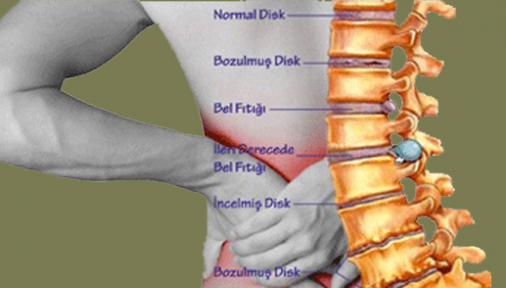 Bel Fıtığı Nedir ve Neden Olur?